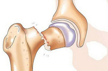 Вколоченный перелом лечение thumbnail