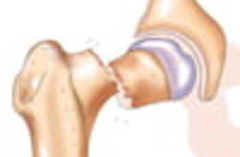 Клиника остеопороза при менопаузе thumbnail