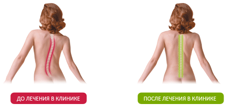 Лечение позвоночника в клинике Бобыря