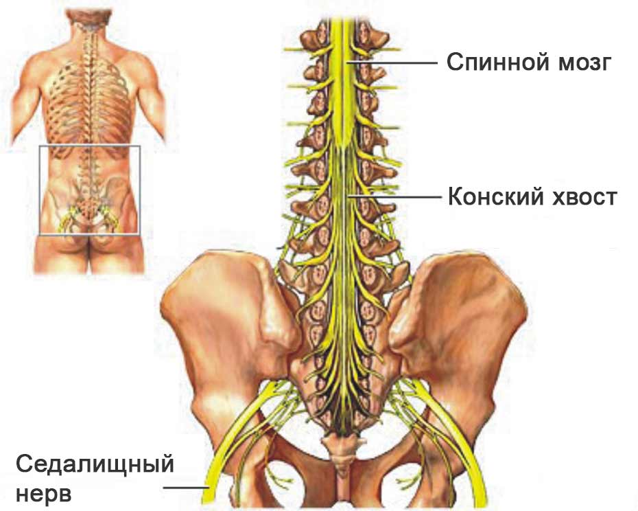 Как Выглядит Поясничная Грыжа Фото