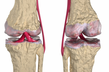 Артрозо-артрит – патология, при которой имеет место разрушение коленного сустава и появление воспаления в очаге поражения. При его развитии необходимо обратиться к врачу. Народными методами можно только временно снять симптомы. 
