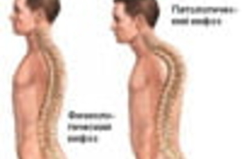 Кифоз - это разновидность искривления позвоночника, при котором он выгибается назад (сутулость, горбатость). У больного кифозом формируется «круглая спина» - неестественное строение тела, при котором плечи отвисают вперед и вниз, грудная клетка сужена, жи