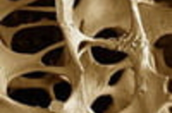 Особенностью остеопороза (болезни, при которой происходит снижение массы костной ткани) является то, что в большинстве случаев неизвестна этиология заболевания.