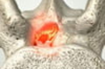 Стеноз позвоночного канала – это заболевание, при котором происходит сужение позвоночного канала из-за выпячивания различных костных, хрящевых и мягкотканых структур.