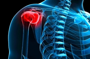 Плечелопаточный периартрит характеризуется воспалением в сухожилиях и капсуле сустава плеча. В то же время остальные суставные элементы не поражаются. Это отличает периартрит плеча и лопатки от таких заболеваний как артрит, артроз.