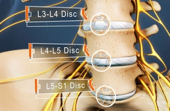Протрузия дисков l4-l5 и l5-s1 – это смещение поясничных дисков из позвоночного столба. Смещение происходит из-за частых и больших нагрузок на эти отделы позвоночника. Если данную болезнь не лечить и запустить, то может развиться межпозвонковая грыжа.