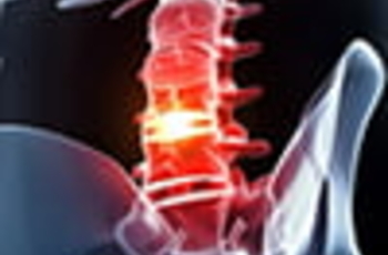 Корешковый (компрессионный) синдром возникает из-за поражения, в данном случае, сдавливания спинномозгового нерва в месте выхода его из ствола, то есть в корне. Считается распространённым неврологическим заболеванием и имеет широкий спектр признаков.