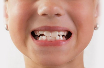 Больше половины людей в мире страдают от неправильного прикуса. Четверть из них даже не знают, что у них нарушено смыкание зубов. В то время как такая, казалось бы, незначительная проблема может привести к серьезному ухудшению здоровья в будущем.