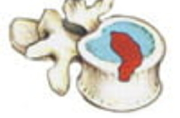 Грыжей Шморля называют выпячивание хрящевого сегмента вглубь губчатой структуры позвонков. Это патологическое изменение в позвоночнике получило своё название в честь немецкого анатома Х. Г. Шморля, который впервые описал его в 1927 году.