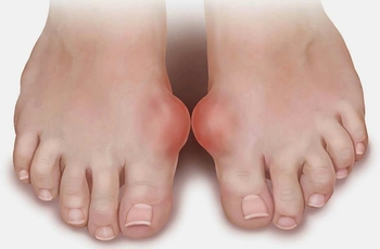 По статистике от воспаления сустава на ногах чаще всего страдают женщины в возрасте от 25 лет и старше. Чтобы избежать заболевания необходимо использовать ортопедическую обувь. Но не всегда данные метод является причиной заболевания.