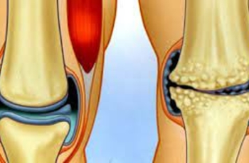 Гонартроз – один из наиболее частых видов поражения коленного сустава. Дегенеративные изменения хрящевой ткани склонны к распространению на окружающие структуры, поэтому при данной патологии важно обратиться к врачу как можно раньше.