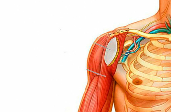 Плексит вызывается воспалением нервов в плечевом сплетении. Болезнь может развиться у людей самых различных возрастных категорий людей, требует незамедлительного лечения, так как может привести к полному параличу руки.