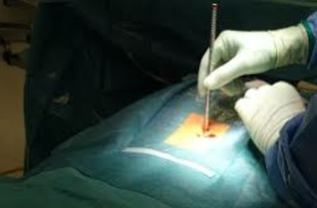 Микродискэктомия – это операция по удалению кусочка костной ткани позвонка над нервным корешком или удаление кусочка межпозвонкового диска под ним для устранения его сдавливания при межпозвонковой грыже.