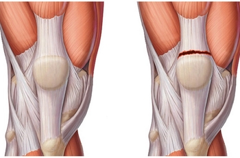 Четырехглавая мышца бедра – квадрицепс – является самой массивной мышцей в теле человека. Без здоровой, нормально функционирующей мышцы невозможно сгибание и разгибание не только коленного сустава, но и бедра.