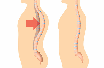 Плосковогнутой спиной называют искривление позвоночного столба, при котором уменьшился изгиб физиологического кифоза в грудном отделе и немного сгладился лордоз в поясничном. Это состояние может быть опасным для организма.