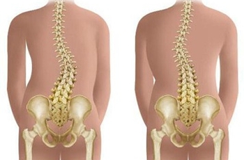 Сколиоз – довольно распространенное заболевание спины, характеризующееся боковым отклонением позвоночной оси от естественного нормального состояния. Как правило, заболевание возникает в раннем возрасте, быстро прогрессирует во время интенсивного роста орг