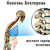 Данное заболевание на сегодняшний день довольно неплохо изучено, поэтому обладая всеми данными о болезни, при правильном лечении можно значительно улучшить состояние пациента. Но давайте разберёмся во всём по порядку.