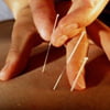Иглоукалывание очень древний способ китайского врачевания. Был разработан специально для снятия болевых эффектов. Для него необходимы очень точные знания анатомии, нахождения всех нервных точек на теле человека. Такой способ лечения применяется для снятия