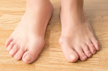 При вальгусной деформации стоп поражается сустав большого пальца на одной из ног. Чтоб избежать серьёзных последствий, нужно вовремя начать лечение. В некоторых случаях выбрать метод можно самостоятельно, в других – с помощью врача.