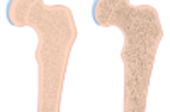 Остеопорозом называется прогрессирующая болезнь скелета. При этом масса кости снижается, а также нарушается структура костной ткани. Таким образом увеличивается хрупкость кости и возникает повышенный риск переломов.