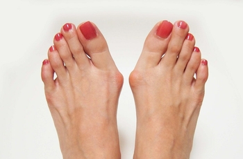 Многих женщин беспокоит заболевание Hallux Valgus. Оно связано с искривлением больших пальцев ног. Данный недуг не только портит внешний вид стоп, но и причиняет боль, поэтому его следует обязательно лечить с помощью специальной шины.