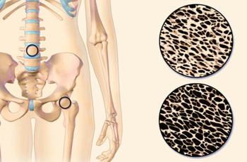 Остеопорозом называют заболевание костей, которое проявляется уменьшением костной массы, изменением их микроструктуры и как следствие - повышение их  хрупкости и ломкости. Часто это заболевание протекает бессимптомно и диагностируется, как правило, уже  п