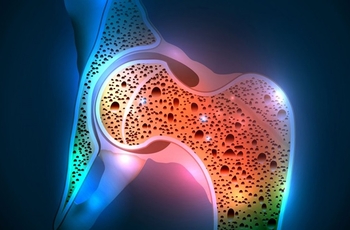 Остеопороз - заболевание костной ткани, которое проявляется прогрессивным снижением ее плотности. В результате даже минимальное физическое усилие может закончиться переломом. Если у пациента выраженный остеопороз, то переломы случаются и при воздействии в