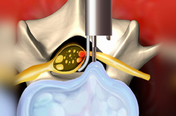 При лечении позвоночной грыжи часто применяется новая процедура - эндоскопическая дискектомия. Данная операция позволяет при помощи оптического прибора-эндоскопа и  специальных хирургических инструментов удалить смещенный межпозвоночный диск через маленьк