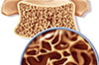 Остеопороз – заболевание костных тканей, при котором они становятся хрупкими и ломкими. Считается неизлечимой болезнью, но при адекватной терапии состояние пациента можно стабилизировать, вернуть трудоспособность и улучшить качество жизни. Народные средст