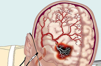 Остеохондроз – заболевание скелета, при котором происходит разрушение хрящевых тканей межпозвоночных дисков. Достаточно часто деформации дисков в шейном участке вызывают компрессию кровеносных сосудов и нарушение кровообращения головного мозга. На начальн