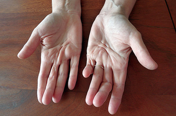 Контрактура – это патологическое состояние, при котором человеку становятся невозможным движение пальцами, присутствует боль в суставах. В данной статье вы узнаете причины возникновения, и как лечить данную патологию в домашних условиях.