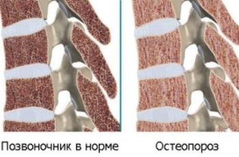 Остеопороз – достаточно распространенное возрастное заболевание костной ткани скелета человека. Он характеризуется хронической утратой костной массы, в результате чего кости становятся хрупкими и ломкими, существенно возрастает риск внезапных переломов. П