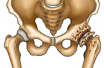 Коксартроз поражает тазобедренный сустав. Появляются костные разрастания. Патологические процессы редко диагностируют на ранних этапах. Симптоматика схожа по признакам с другими болезнями. Как же выявить и вылечить коксартроз?