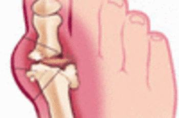 Появление шишек в области больших пальцев ног может стать проблемой. И если пока, на начальном этапе беспокоит только внешний вид, то потом еще присоединятся боли. Поэтому следует вовремя начать бить тревогу и приступить к лечению.