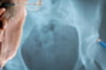 Остеопороз - это болезнь, при которой уменьшается плотность костной ткани, снижается ее прочность и увеличивается риск перелома. Подобные случаи возникают тогда, когда в организме недостаточное количество кальция и других минеральных веществ или некоторые